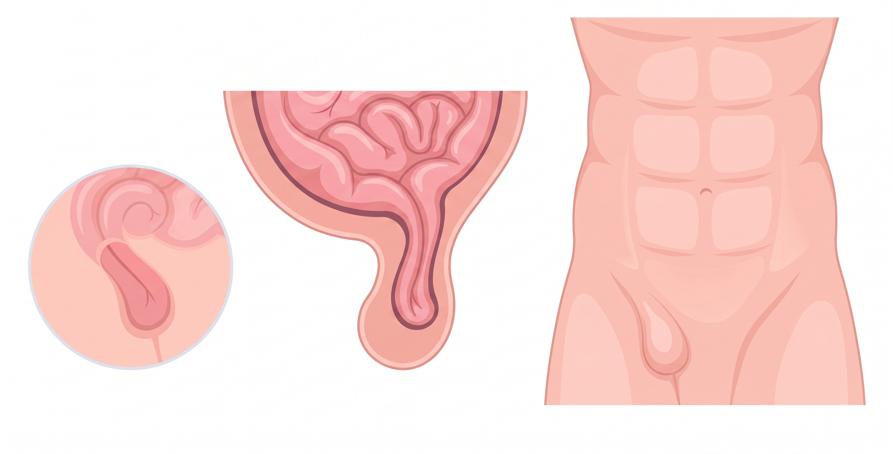 What Exactly Is a Hernia?